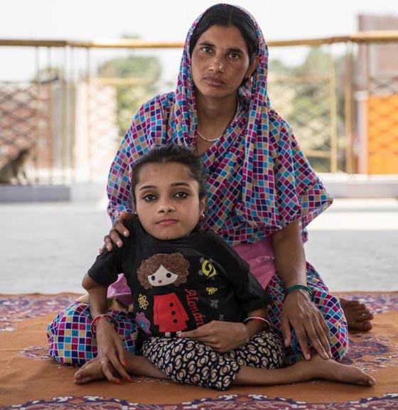  صور غريبة: مراهقة هندية كُسرت عظامها 1000 مرة بسبب مرض نادر  صورة رقم 11