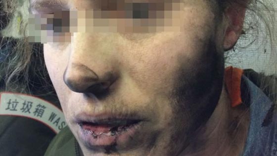  شابة تصاب بحروق في وجهها ويديها لانفجار سماعات الرأس برحلة جوية  صورة رقم 2