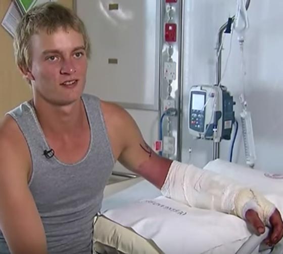  مراهق يحاول إبهار صديقته في رهان فيتعرض لـ (عضة تمساح)! صورة رقم 1