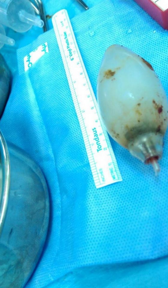  مذهل.. استخراج مصباح كهربائي من بطن شاب ابتلعه قبل 11 عاما! صورة رقم 2