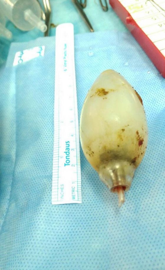  مذهل.. استخراج مصباح كهربائي من بطن شاب ابتلعه قبل 11 عاما! صورة رقم 3