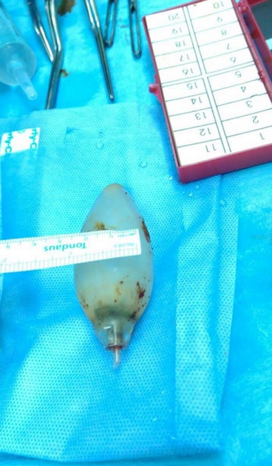  مذهل.. استخراج مصباح كهربائي من بطن شاب ابتلعه قبل 11 عاما! صورة رقم 4