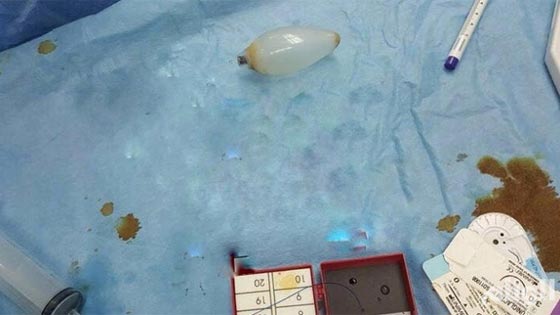  مذهل.. استخراج مصباح كهربائي من بطن شاب ابتلعه قبل 11 عاما! صورة رقم 1