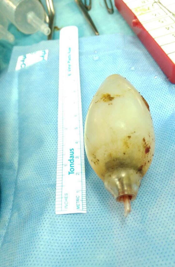  مذهل.. استخراج مصباح كهربائي من بطن شاب ابتلعه قبل 11 عاما! صورة رقم 5