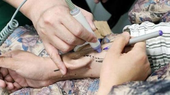 فيديو وصور.. اطباء ينقلون أذن رجل من يده الى مكانها الطبيعي! صورة رقم 2