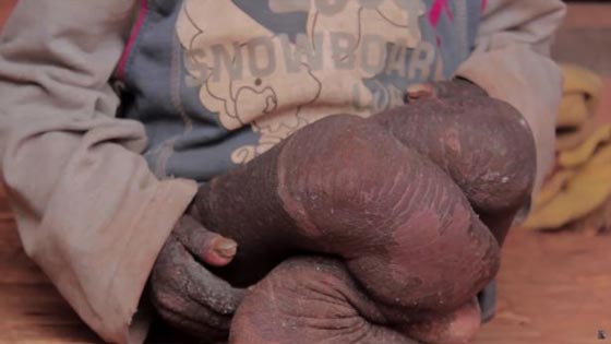  صور صادمة: طفل هندي يتحول الى حجر بسبب مرض نادر! صورة رقم 6