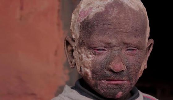  صور صادمة: طفل هندي يتحول الى حجر بسبب مرض نادر! صورة رقم 7