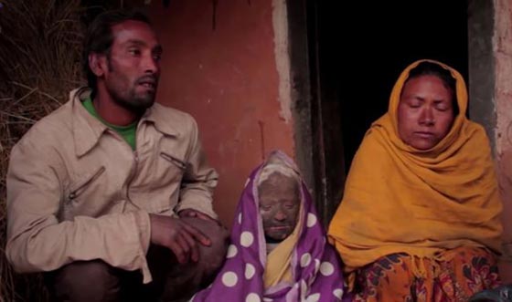  صور صادمة: طفل هندي يتحول الى حجر بسبب مرض نادر! صورة رقم 8