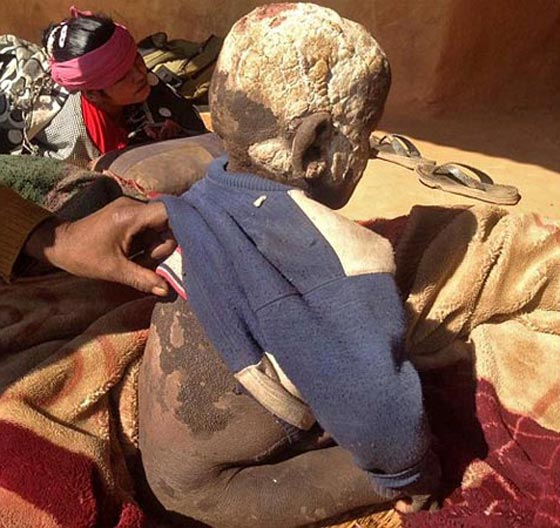  صور صادمة: طفل هندي يتحول الى حجر بسبب مرض نادر! صورة رقم 3