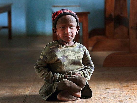  صور صادمة: طفل هندي يتحول الى حجر بسبب مرض نادر! صورة رقم 4