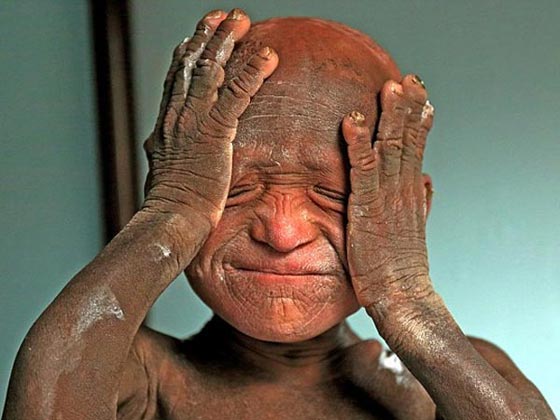  صور صادمة: طفل هندي يتحول الى حجر بسبب مرض نادر! صورة رقم 5