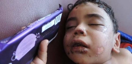 صور مؤلمة: مصري يعذب ابن زوجته، يكويه بالنار ويقتلع اظافره  صورة رقم 3