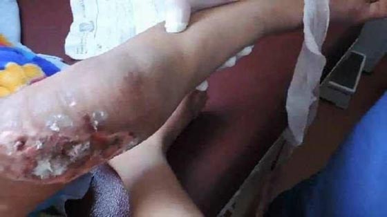 صور مؤلمة: مصري يعذب ابن زوجته، يكويه بالنار ويقتلع اظافره  صورة رقم 1