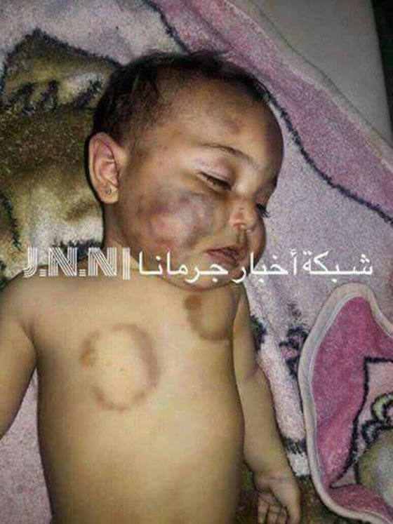 صور مروعة.. اب سوري يقتل طفلته البالغة 9 اشهر عضا باسنانه! صورة رقم 2