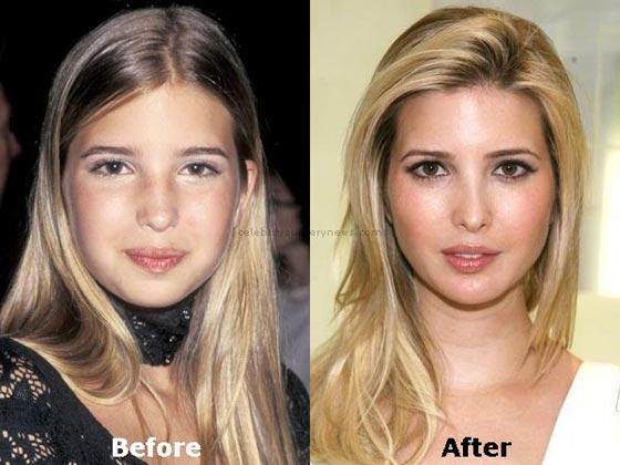 لن تصدقوا كيف كان شكل ايفانكا ترامب! صور قبل وبعد عمليات التجميل! صورة رقم 19