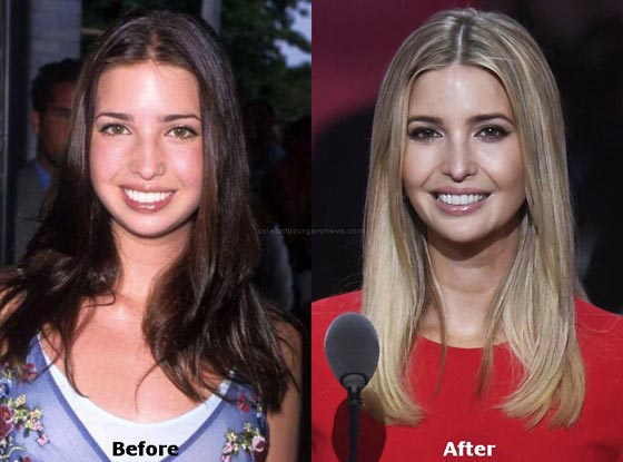 لن تصدقوا كيف كان شكل ايفانكا ترامب! صور قبل وبعد عمليات التجميل! صورة رقم 20