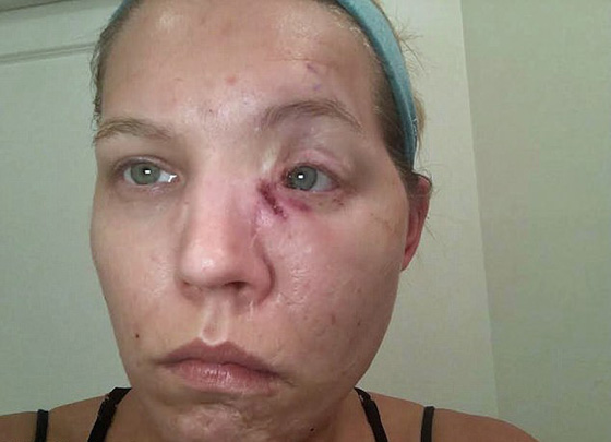  عارضة أزياء ترفض الخروج من بيتها طيلة 6 سنوات بعد أن تشوه وجهها! صورة رقم 2