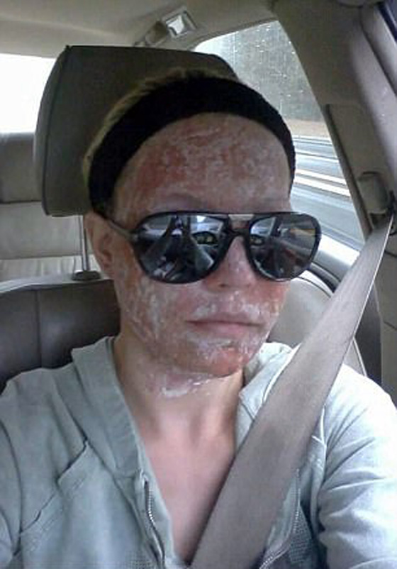  عارضة أزياء ترفض الخروج من بيتها طيلة 6 سنوات بعد أن تشوه وجهها! صورة رقم 4