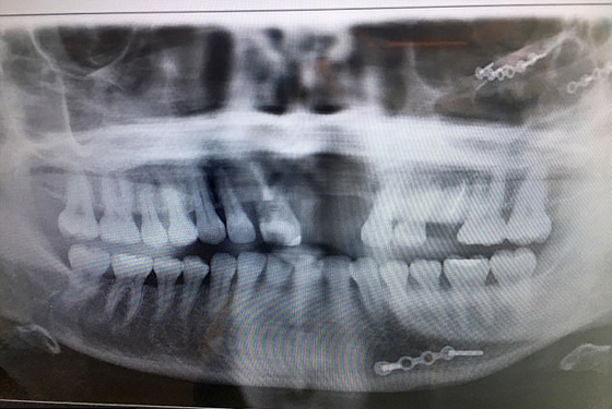  عارضة أزياء ترفض الخروج من بيتها طيلة 6 سنوات بعد أن تشوه وجهها! صورة رقم 7