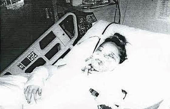  عارضة أزياء ترفض الخروج من بيتها طيلة 6 سنوات بعد أن تشوه وجهها! صورة رقم 6