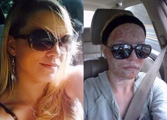  عارضة أزياء ترفض الخروج من بيتها طيلة 6 سنوات بعد أن تشوه وجهها! صورة رقم 1