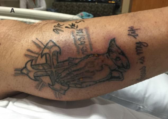 تجاهل توصيات خبير الوشوم بتجنب السباحة فمات بالبكتيريا آكلة اللحم صورة رقم 2