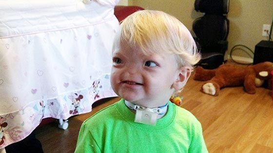 عائلة الطفل المعجزة المولود بدون انف تعلن وفاته عن عمر سنتين! صورة رقم 1