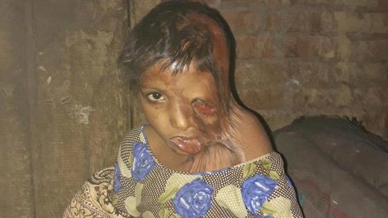 صور مؤلمة.. عودة الامل لطفلة ذاب وجهها بسبب نزاع بين والديها  صورة رقم 4