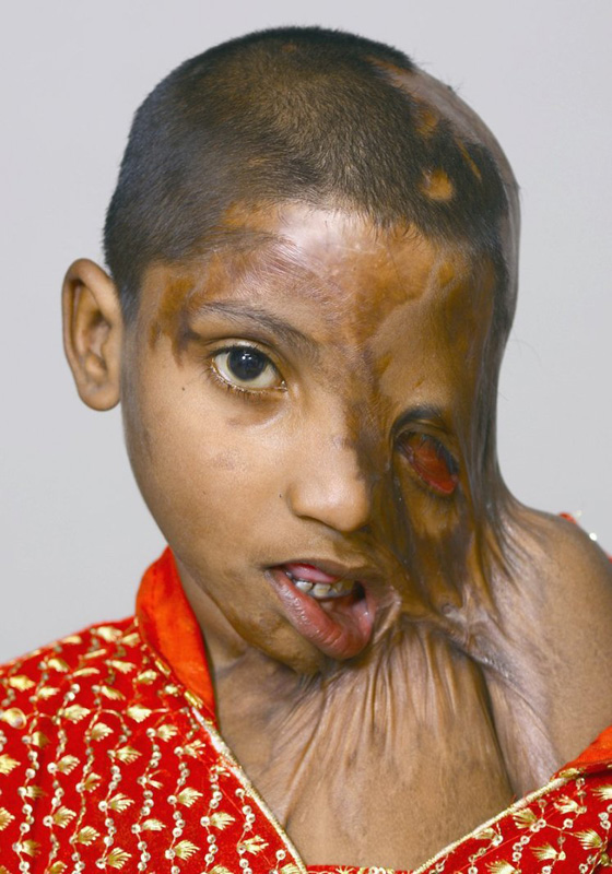 صور مؤلمة.. عودة الامل لطفلة ذاب وجهها بسبب نزاع بين والديها  صورة رقم 1