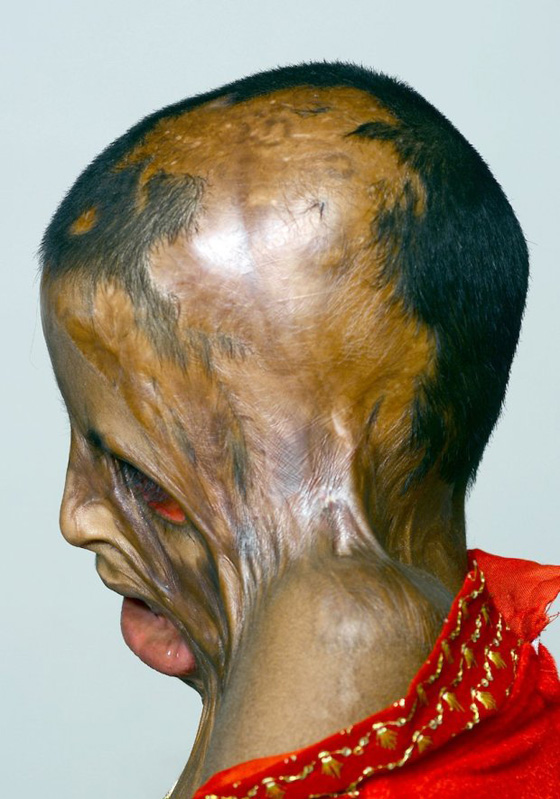 صور مؤلمة.. عودة الامل لطفلة ذاب وجهها بسبب نزاع بين والديها  صورة رقم 2