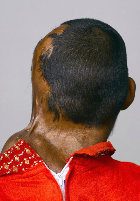 صور مؤلمة.. عودة الامل لطفلة ذاب وجهها بسبب نزاع بين والديها  صورة رقم 3