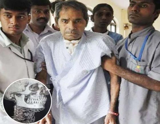 رجل هندي حير الاطباء بعد ان عثروا على 150 دبوسا غرست في جسده صورة رقم 2