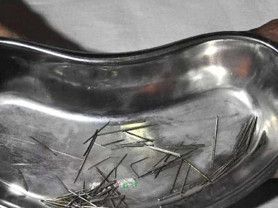 رجل هندي حير الاطباء بعد ان عثروا على 150 دبوسا غرست في جسده صورة رقم 9