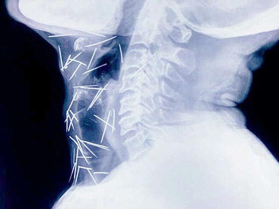 رجل هندي حير الاطباء بعد ان عثروا على 150 دبوسا غرست في جسده صورة رقم 6