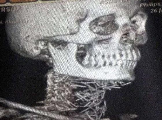 رجل هندي حير الاطباء بعد ان عثروا على 150 دبوسا غرست في جسده صورة رقم 1