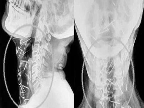 رجل هندي حير الاطباء بعد ان عثروا على 150 دبوسا غرست في جسده صورة رقم 4