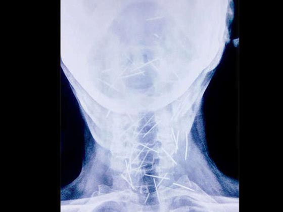 رجل هندي حير الاطباء بعد ان عثروا على 150 دبوسا غرست في جسده صورة رقم 5