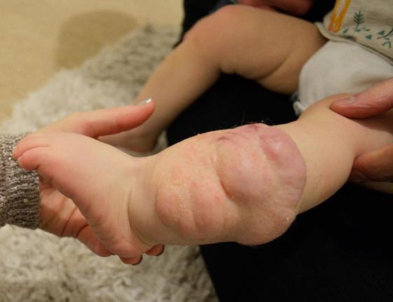 فيديو مؤثر.. طفل يمشي أولى خطواته قبل خضوعه لجراحة بترت فيها ساقه! صورة رقم 3