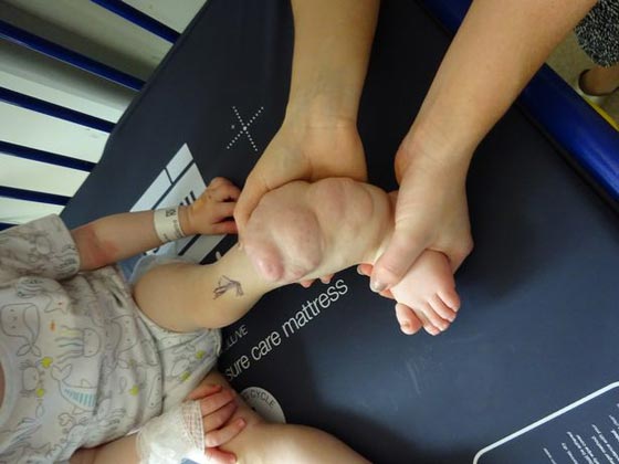 فيديو مؤثر.. طفل يمشي أولى خطواته قبل خضوعه لجراحة بترت فيها ساقه! صورة رقم 2