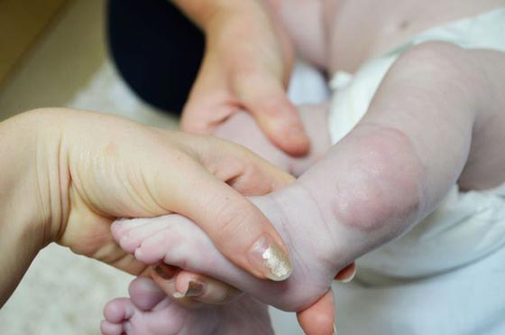 فيديو مؤثر.. طفل يمشي أولى خطواته قبل خضوعه لجراحة بترت فيها ساقه! صورة رقم 1