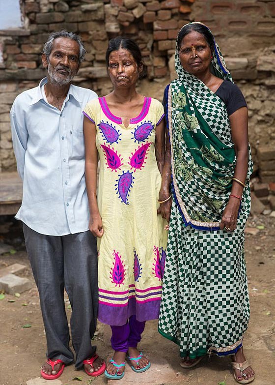 أم وابنتها تعيشان مع رجل شوههما بماء النار.. فيديو وصور صورة رقم 2