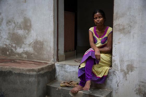 أم وابنتها تعيشان مع رجل شوههما بماء النار.. فيديو وصور صورة رقم 4