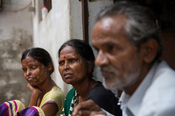 أم وابنتها تعيشان مع رجل شوههما بماء النار.. فيديو وصور صورة رقم 5