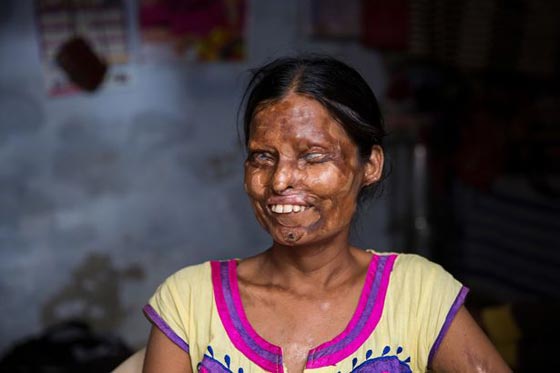 أم وابنتها تعيشان مع رجل شوههما بماء النار.. فيديو وصور صورة رقم 1