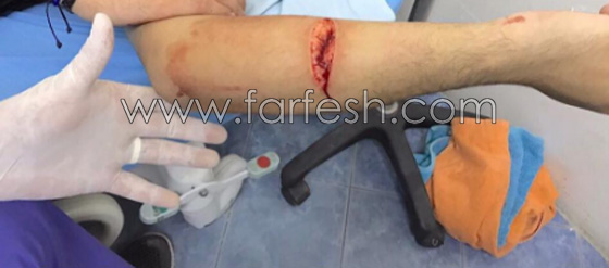 صور مينا عطا نجم ستار اكاديمي في المستشفى بسبب جرح عميق في ذراعه صورة رقم 3