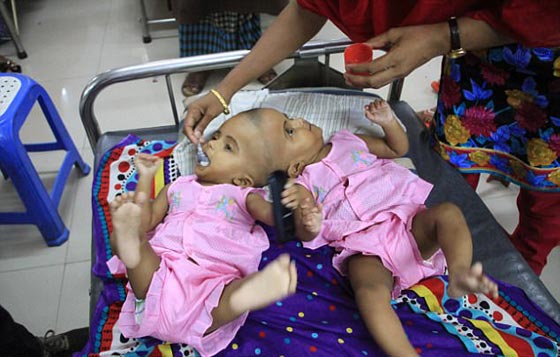 أخيرًا عملية لفصل التوأم الملتصق من الرأس رقية وربيعة صورة رقم 3