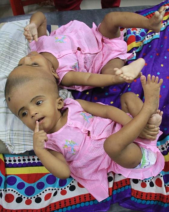 أخيرًا عملية لفصل التوأم الملتصق من الرأس رقية وربيعة صورة رقم 4