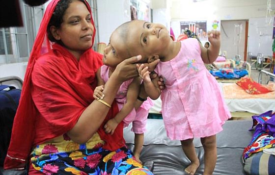 أخيرًا عملية لفصل التوأم الملتصق من الرأس رقية وربيعة صورة رقم 5