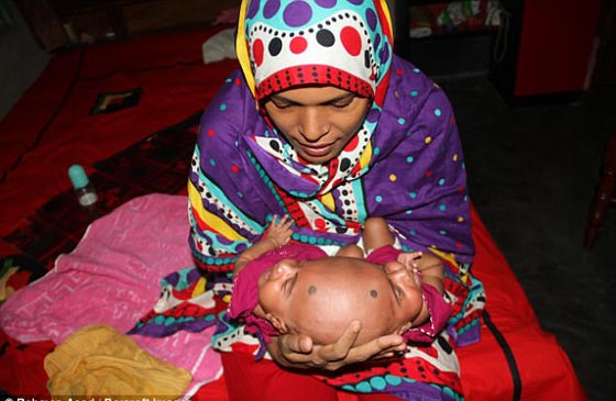 أخيرًا عملية لفصل التوأم الملتصق من الرأس رقية وربيعة صورة رقم 7