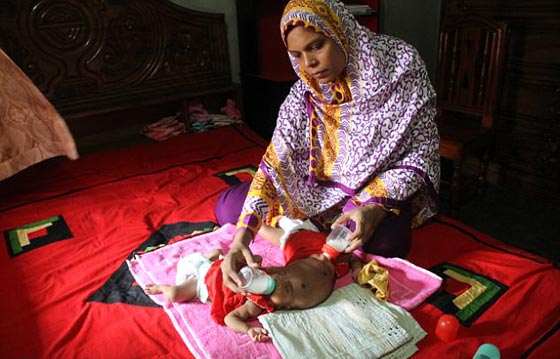 أخيرًا عملية لفصل التوأم الملتصق من الرأس رقية وربيعة صورة رقم 8